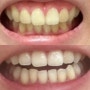 [강력추천] 치아 미백 누렁니 탈출 내돈내산 찐후기 - 크레스트3D 화이트 스트립스