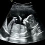 [임신 일기] 6화. 16주 2차 기형아 검사 그리고 알게된 성별!! (+마벨르 산후조리원)