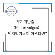 [인천송도PT, 무지외반증 (Hallux valgus) ] 엄지발가락이 아프다면?