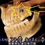 대학병원 전신마취 수술 권유 받은 상악동 치아 뿌리끝 치근단 낭종 국소마취 로 인천 부평 치과 에서 해결하기