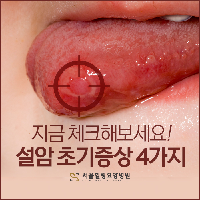 지금 체크해보세요! 설암 초기증상 4가지. : 네이버 블로그
