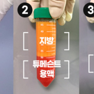 가슴지방이식의 종류 (1)