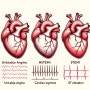 급성관상동맥증후군(Acute Coronary Syndrome, ACS)