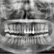덕계역치과 파절된 치아 발거 후 임플란트한 케이스