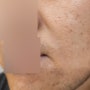 신논현피부과 : 팔자주름개선 "엠보쎄라" 남자주름관리 전후, 통증