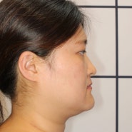 주걱턱 교정 TTBA 교정기 비발치 치료 결과 비교