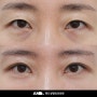 사나워 보이는 눈매, 앞트임 복구 없이 개선하는 방법 소개 / 눈썹하거상과 눈재수술 경과