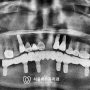 불광역치과 심한 마모도의 치아를 가진 환자에 있어서 전악임플란트 수복