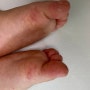 아기 수족구 증상 손, 발, 입 발진 및 수포