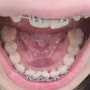 20대 후반 부정교합 치아교정 후기 (9) 4월 교정장치 교체, 치위생사별 치아관리