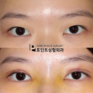 불룩한 눈두덩이의 눈지방제거는 부분절개 쌍꺼풀 수술로 포인트성형외과 수술전후사진