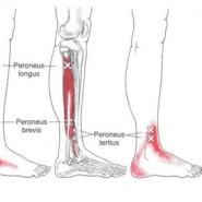 알통 Series 3 - 발바닥 통증(foot pain) : 단비골근(Fibularis brevis)