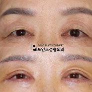 어르신 눈꺼풀처짐 상안검 눈썹하거상 수술전후사진 포인트성형외과