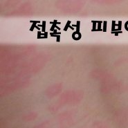 [OR] 접촉성 피부염(Contact dermatitis)