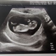 임신 10주, 11주, 12주 - 입덧과 1차기형아검사 후기