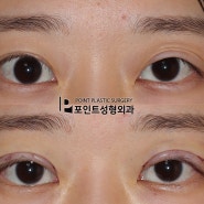 풀린쌍꺼풀 재수술 짝눈교정 수술전후사진 포인트성형외과