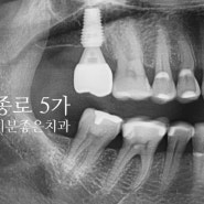 종로 5가 치과에서 임플란트를 보험으로 진행하세요!