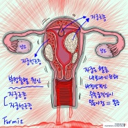 생리후 부정출혈 하혈하는 이유 분명 있다