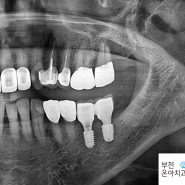 부천 치과, 사랑니 발치 대신 보철 치료는 안 되나요?