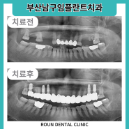 부산남구임플란트치과 치아를 상실했다면