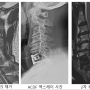 목디스크 허리디스크 다리 힘빠짐