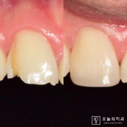 레진치료 전문 신중동 오늘의 치과 에서는 치아 끝단의 투명층까지 자연스럽게 재현해드립니다.