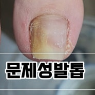 부산서면 롯데백화점 근처 무좀내성문제성발톱 가격싼곳