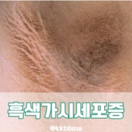 흑색가시세포증 원인 연고로 치료 가능할까?