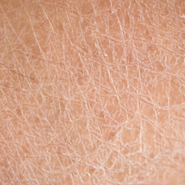 피부 건조증 가려움 종결하는 방법은?