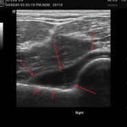 (팔꿈치)팔꿈치 피고임, 혈주관절,hemarthrosis elbow