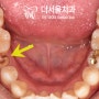 20대 임플란트 해야 된다면? 디지털 네비게이션 가이드로 튼튼하게 평생 사용하세요 성남 치과 추천