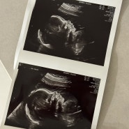 22-25w 임신일기 | 임신당뇨검사 및 정밀초음파