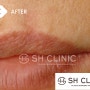 입술흉터 치료를 위한 두차례의 리페어 레이저 시술 후 완치 사례(사고로 남은 외상성 흉터 치료) .SH클리닉