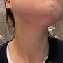 [송파구피부과] 인모드FX 통증 멍 이중턱 솔직후기 (+프락셀, 어펌레이저) / 인모드병원