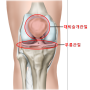 무릎 앞쪽의 통증, 슬개골 통증 / 슬개대퇴관절염, 슬개대퇴통증증후군, 슬개골연골연화증 / 일산 가로세로한의원