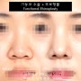 비중격 만곡증 교정 + 무보형물 기능코 수술 후기 【Dr. 아베크 코성형】