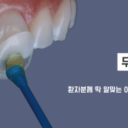 치아삭제 고민 끝! 무삭제 라미네이트