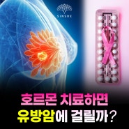 여성 호르몬 치료하면 유방암 걸릴까?