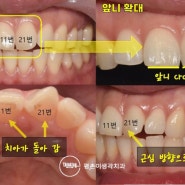 호계동치과 앞니 틀어짐 총생 문제, 올바른 정의를 내리자면 바로 '이것'입니다.