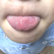 아이 혀 염증 설염 지도설염 갈라짐 원인 이비인후과 진료 (프로폴리스 스프레이)