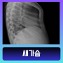 새가슴 뜻 교정 남자