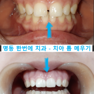 학생 치아 틈 메우기 - 명동 한번에 치과