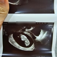 쌍둥이 임신 9주 10주 입덧 지옥