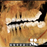 사랑니 발치 후 거즈 솜 얼마나 물고있어야 할까? 믿음가는 치과 에서 gauze biting 지혈법에 대해 설명해 드립니다