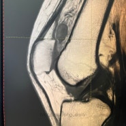 PVNS(색소 융모 결절성 활액막염) 무릎 관절내시경 수술 후기