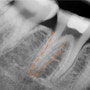 근관치료 시 치과의사를 힘들게 하는 하악 대구치 DL root ‘Radix Entomolaris’ (울산 삼산동 근관치료 신경치료)