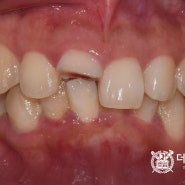 앞니 치아파절, 자연치 보존하는 포스트&코어 크라운 치료