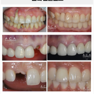 앞니임플란트잘하는곳 내 치아처럼 자연스럽고 튼튼하게
