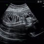 광주 미즈피아산부인과 21주 임신 정밀초음파