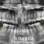 "임플란트 수술 무서워요." 성남 치과 에서 수면 마취 후 디지털 임플란트 로 좌우 어금니 한 번에 진행해 드립니다.